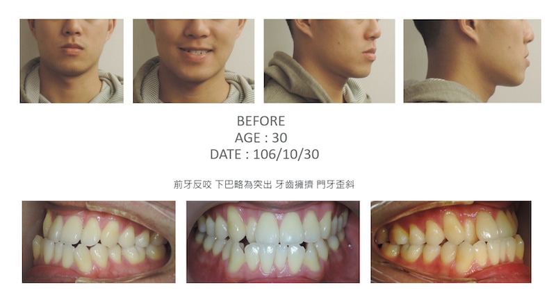 隱適美-隱形矯正-反咬-戽斗-牙齒擁擠-牙齒矯正前-台中隱適美推薦-楊念珊