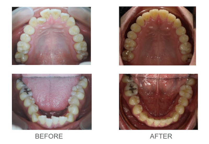 隱適美-隱形矯正-反咬-戽斗-牙齒擁擠-牙齒矯正前後 -台中隱適美推薦-楊念珊