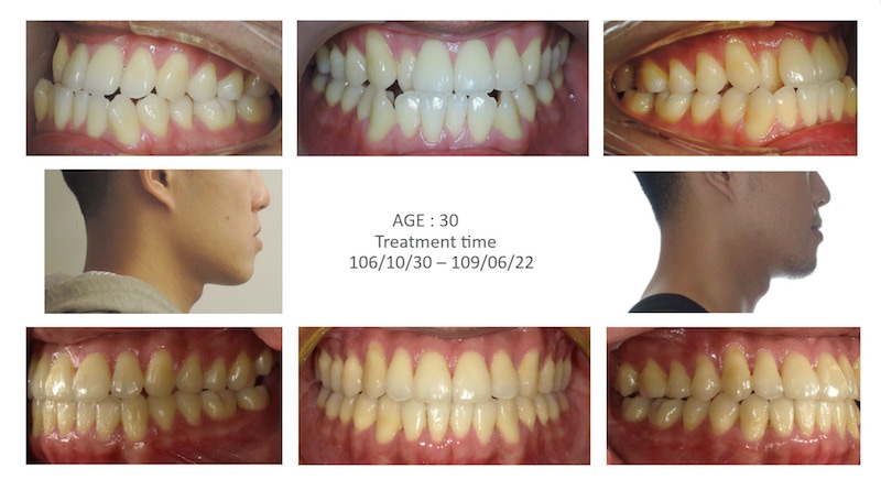 隱適美-隱形矯正-反咬-戽斗-牙齒擁擠-牙齒矯正前後-牙齒變化-台中隱適美推薦-楊念珊