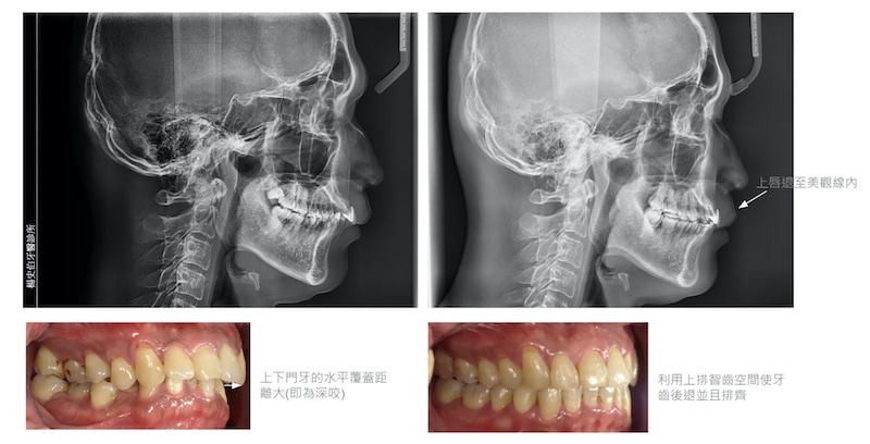 隱適美-隱形矯正-深咬-牙齒擁擠-拔智齒矯正-隱適美骨釘-牙齒矯正前後-上下排牙齒咬合變化-台中隱適美推薦-楊念珊