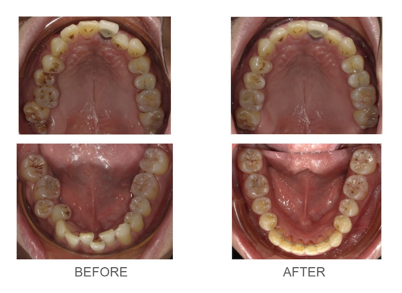 隱適美-隱形矯正-深咬-牙齒擁擠-拔智齒矯正-隱適美骨釘-牙齒矯正前後-台中隱適美推薦-楊念珊