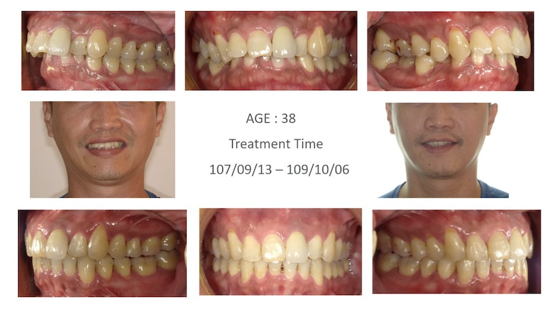 隱適美-隱形矯正-深咬-牙齒擁擠-拔智齒矯正-隱適美骨釘-牙齒矯正前後-牙齒變化-台中隱適美推薦-楊念珊