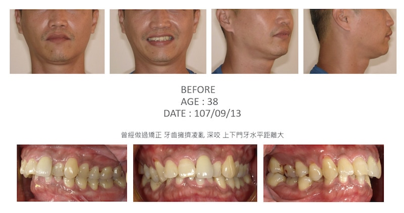 隱適美-隱形矯正-深咬-牙齒擁擠-牙齒矯正前-台中隱適美推薦-楊念珊