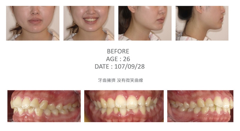 隱適美-隱形矯正-牙齒擁擠-牙齒矯正前-台中隱適美推薦-楊念珊