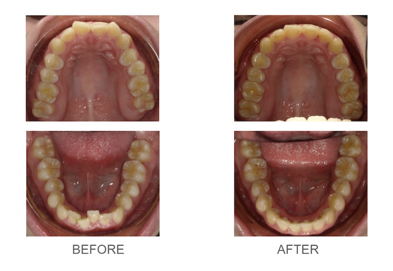 隱適美-隱形矯正-牙齒擁擠-牙齒矯正前後-台中隱適美推薦-楊念珊