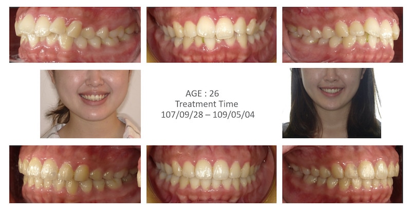 隱適美-隱形矯正-牙齒擁擠-牙齒矯正前後-牙齒變化-台中隱適美推薦-楊念珊