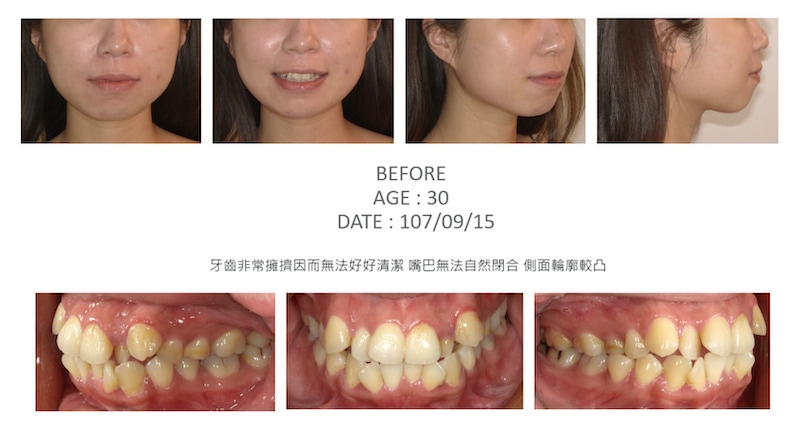 隱適美-隱形矯正-矯正拔小臼齒-牙齒矯正前-台中隱適美推薦-楊念珊醫師