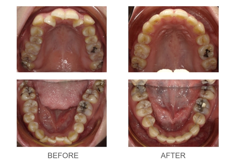 隱適美-隱形矯正-矯正拔小臼齒-牙齒矯正前後-台中隱適美推薦-楊念珊醫師