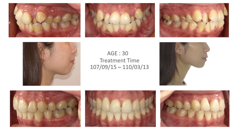 隱適美-隱形矯正-矯正拔小臼齒-牙齒矯正前後-牙齒變化-台中隱適美推薦-楊念珊醫師