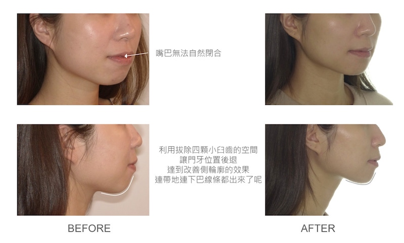 隱適美-隱形矯正-矯正拔小臼齒-牙齒矯正前後-臉型變化-台中隱適美推薦-楊念珊醫師