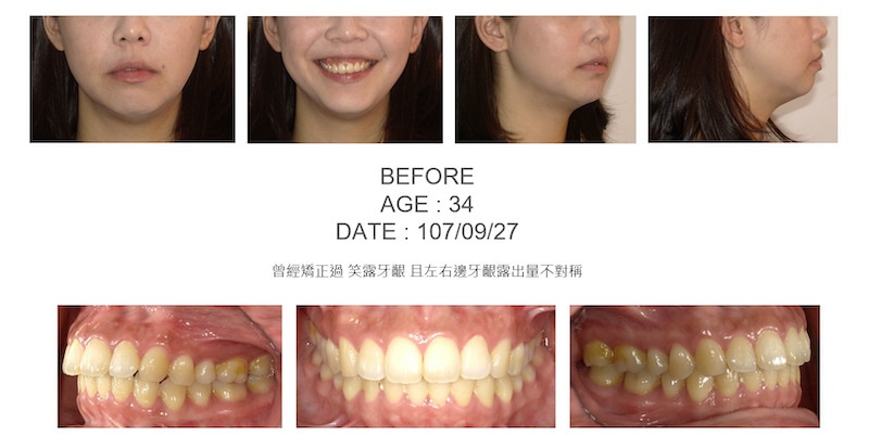 隱適美-隱形矯正-笑露牙齦-牙齦不對稱-隱適美骨釘-牙齒矯正前-台中隱適美推薦-楊念珊