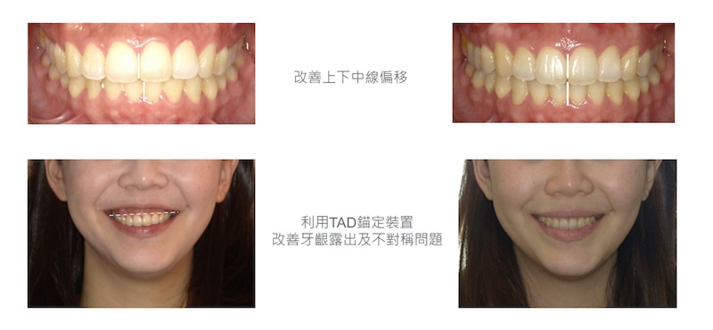隱適美-隱形矯正-笑露牙齦-牙齦不對稱-隱適美骨釘-牙齒矯正前後-台中隱適美推薦-楊念珊