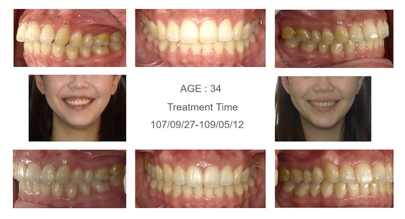隱適美-隱形矯正-笑露牙齦-牙齦不對稱-隱適美骨釘-牙齒矯正前後-牙齒變化-台中隱適美推薦-楊念珊