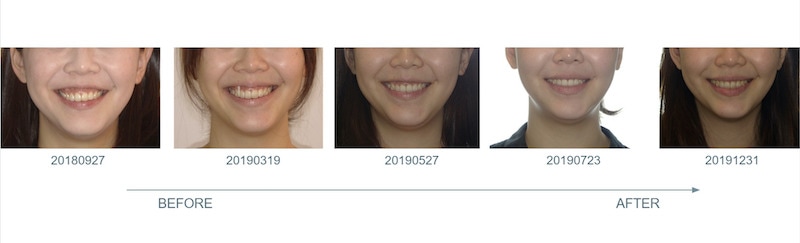 隱適美-隱形矯正-笑露牙齦-牙齦不對稱-隱適美骨釘-牙齒矯正前後-牙齦變化-台中隱適美推薦-楊念珊