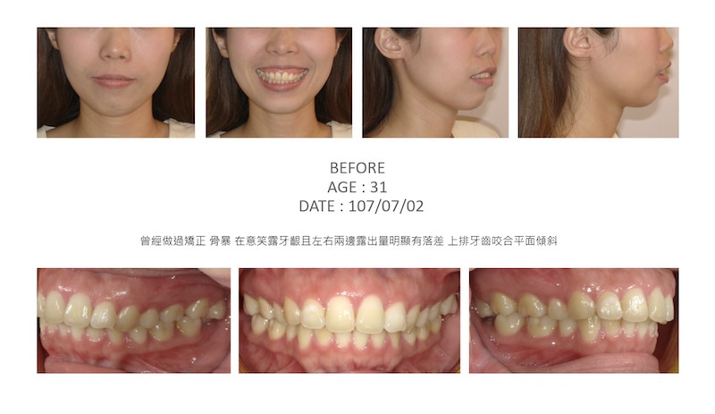 隱適美-隱形矯正-骨暴-笑露牙齦-牙齒矯正前-台中隱適美推薦-楊念珊