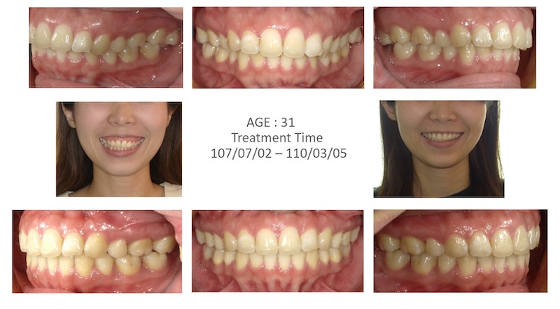 隱適美-隱形矯正-骨暴-笑露牙齦-牙齒矯正前後-牙齒變化-台中隱適美推薦-楊念珊