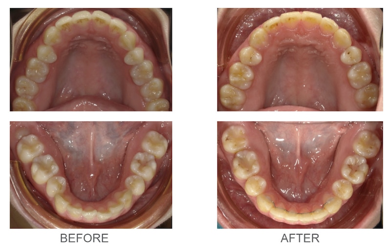 隱適美-隱形矯正-骨暴-笑露牙齦-隱適美骨釘-牙齒矯正前後-台中隱適美推薦-楊念珊