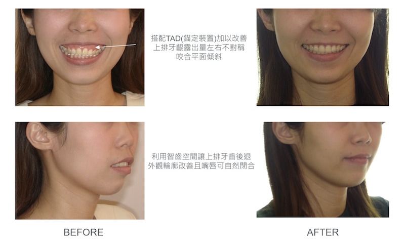 隱適美-隱形矯正-骨暴-笑露牙齦-隱適美骨釘-牙齒矯正前後-牙齒與臉型變化-台中隱適美推薦-楊念珊