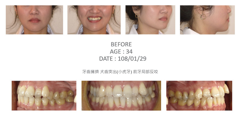 隱適美-隱形矯正-小虎牙-犬齒突出-牙齒擁擠-反咬-牙齒矯正前-台中隱適美推薦-楊念珊