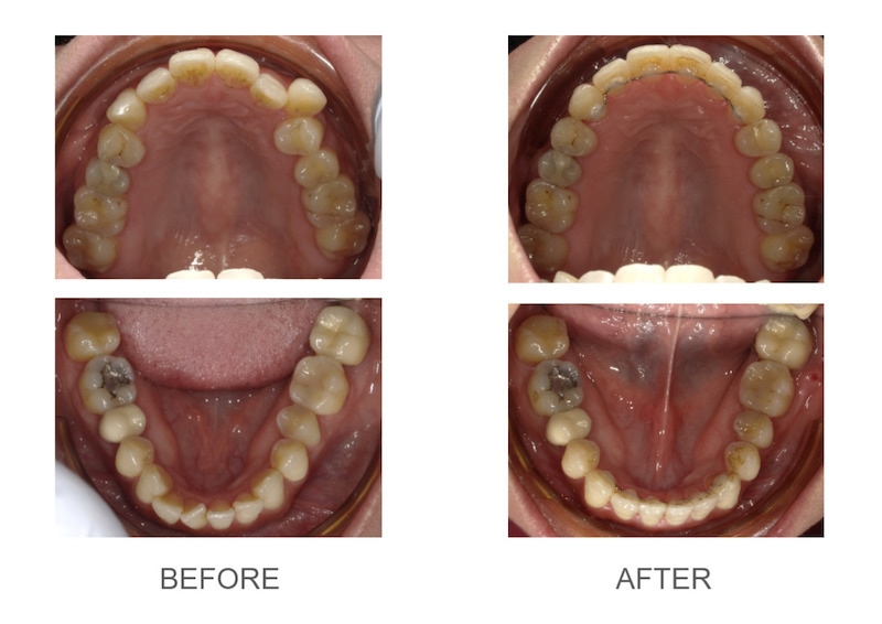 隱適美-隱形矯正-小虎牙-犬齒突出-牙齒擁擠-反咬-牙齒矯正前後-台中隱適美推薦-楊念珊