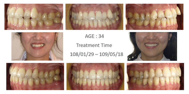 隱適美-隱形矯正-小虎牙-犬齒突出-牙齒擁擠-反咬-牙齒矯正前後-牙齒變化-台中隱適美推薦-楊念珊