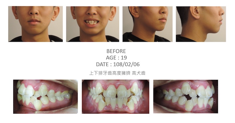 兒童隱適美-隱形矯正-反咬-牙齒擁擠-高犬齒-牙齒矯正前-台中隱適美推薦-楊念珊