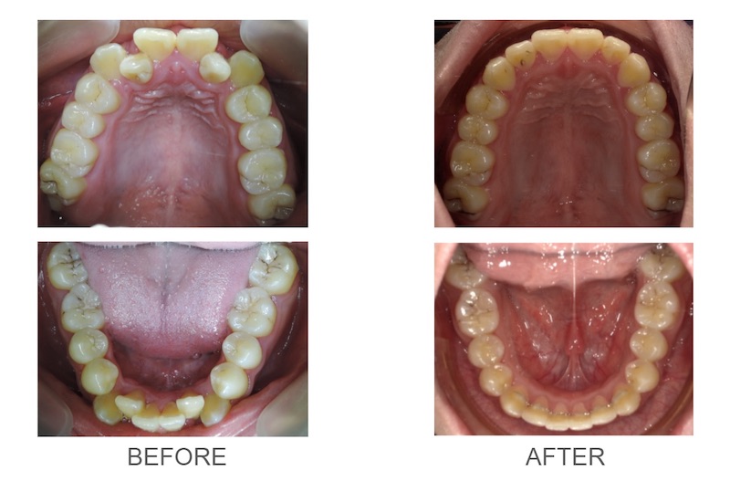 兒童隱適美-隱形矯正-反咬-牙齒擁擠-高犬齒-牙齒矯正前後-台中隱適美推薦-楊念珊