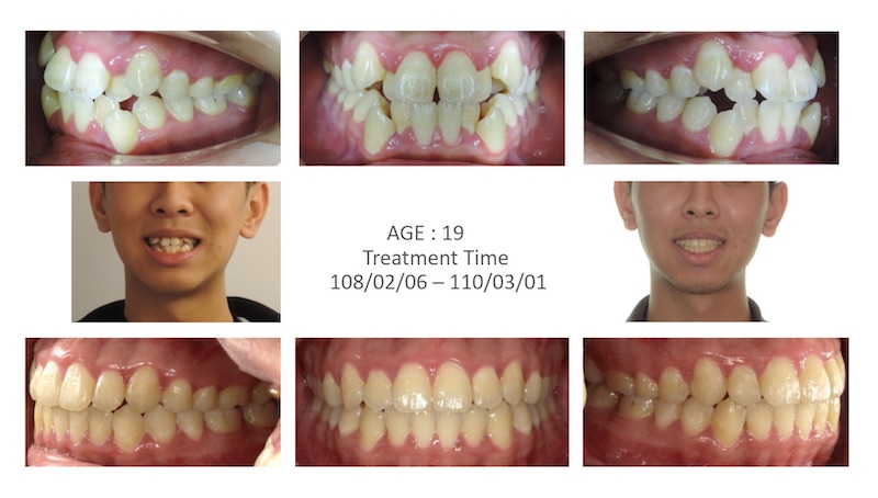 兒童隱適美-隱形矯正-反咬-牙齒擁擠-高犬齒-牙齒矯正前後-牙齒變化-台中隱適美推薦-楊念珊