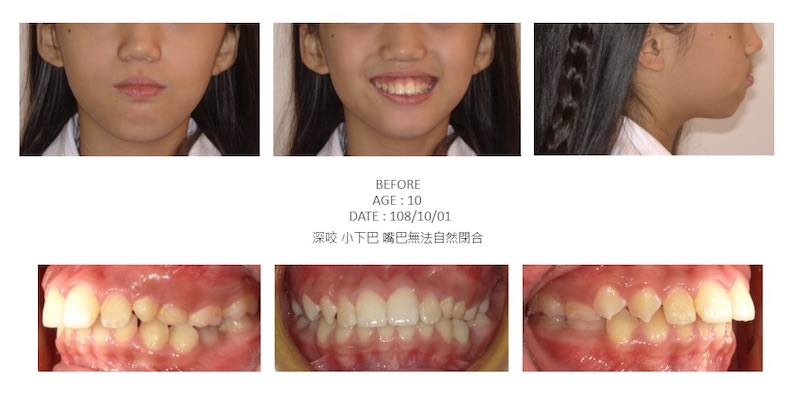 兒童隱適美-隱形矯正-深咬-小下巴-牙齒矯正前-台中隱適美推薦-楊念珊