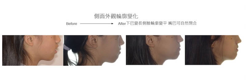 兒童隱適美-隱形矯正-深咬-小下巴-牙齒矯正前後-側面外觀輪廓變化-台中隱適美推薦-楊念珊