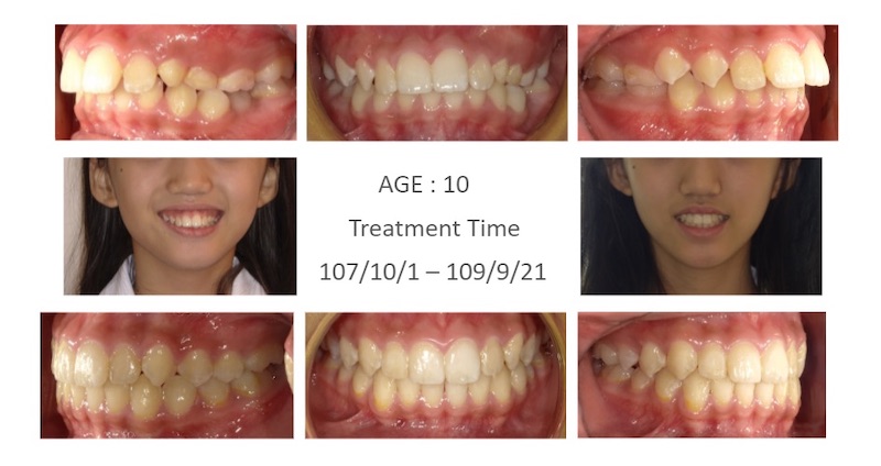 兒童隱適美-隱形矯正-深咬-小下巴-牙齒矯正前後-牙齒變化-台中隱適美推薦-楊念珊