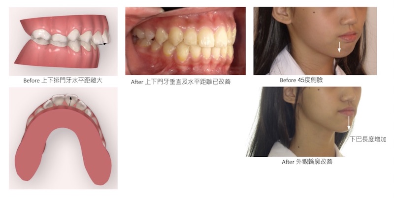 兒童隱適美-隱形矯正-深咬-小下巴-牙齒矯正前後-隱適美模擬與深咬臉型變化-台中隱適美推薦-楊念珊