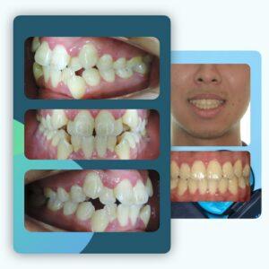 隱適美-兒童牙齒矯正-反咬-牙齒擁擠-高犬齒-台中-牙醫-推薦