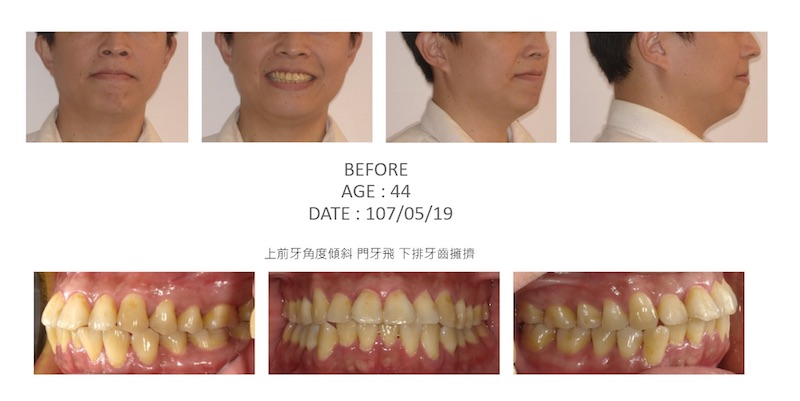 隱適美-隱形矯正-牙齒擁擠-門牙角度傾斜-牙齒矯正前-台中隱適美推薦-楊念珊