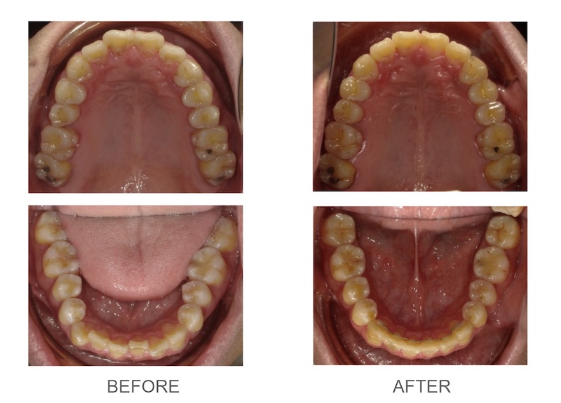隱適美-隱形矯正-牙齒擁擠-門牙角度傾斜-牙齒矯正前後-台中隱適美推薦-楊念珊