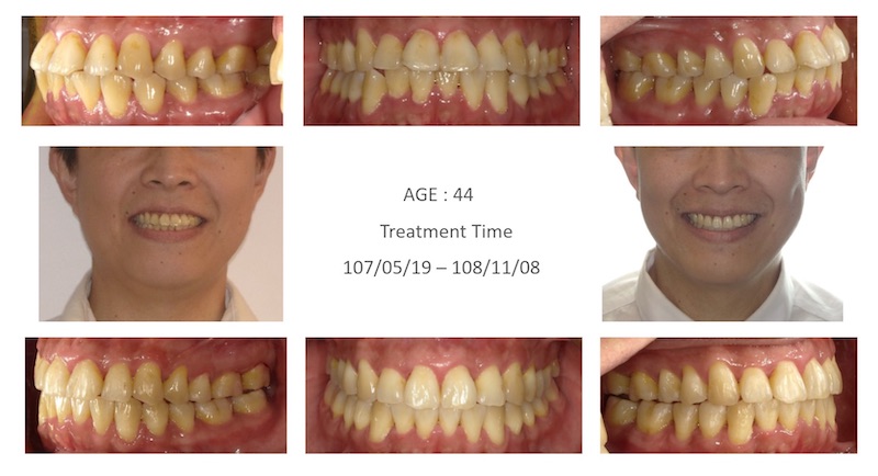 隱適美-隱形矯正-牙齒擁擠-門牙角度傾斜-牙齒矯正前後-牙齒變化-台中隱適美推薦-楊念珊