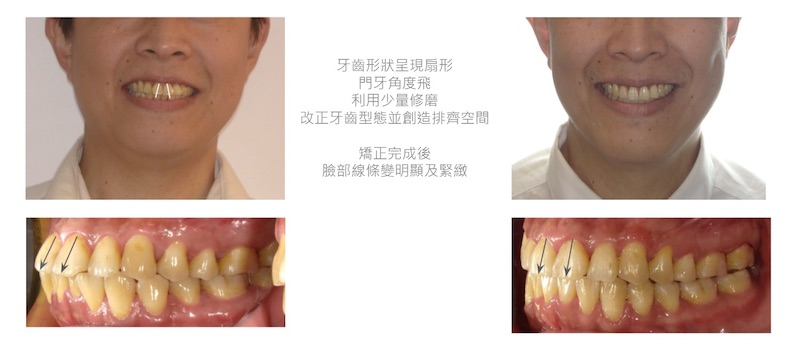 隱適美-隱形矯正-牙齒擁擠-門牙角度傾斜-牙齒矯正前後-門牙角度變化-台中隱適美推薦-楊念珊