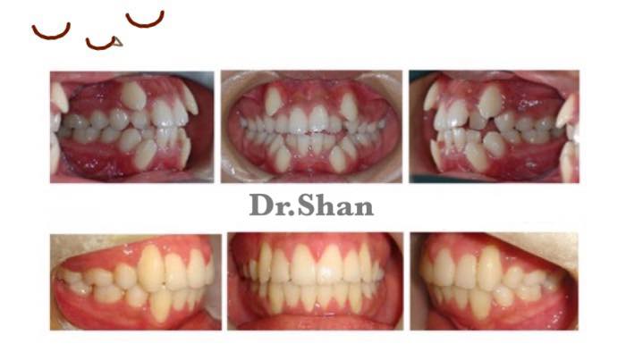 兒童牙齒矯正-兒童口呼吸矯正案例-隱適美矯正前後牙齒比較-台中-楊念珊