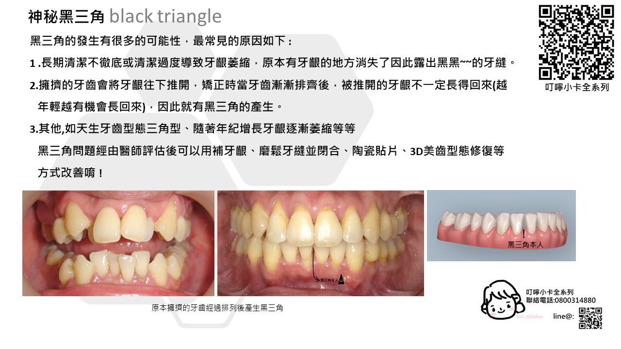 隱適美-隱形牙套-叮嚀小卡10.神秘黑三角-2022-台中隱適美推薦-Dr.珊