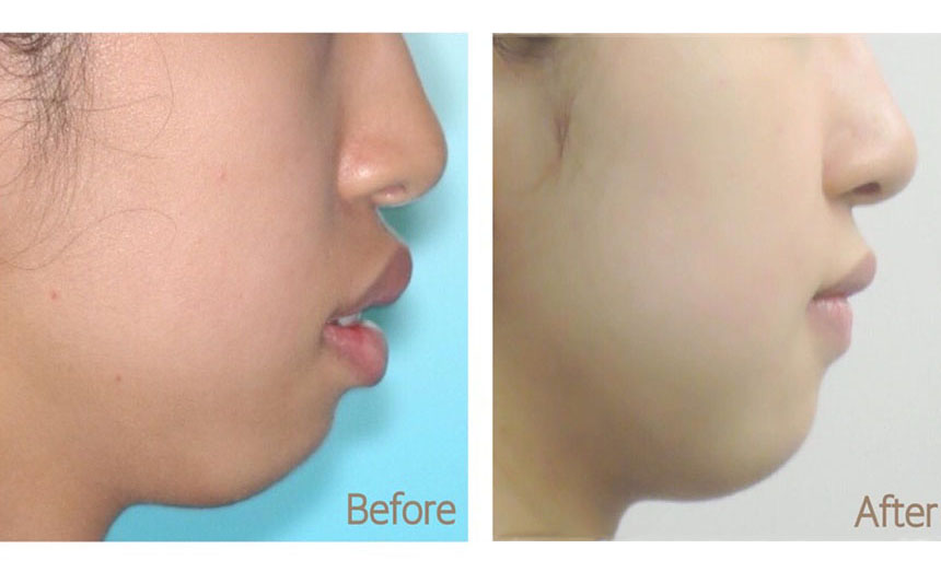 隱適美拔牙-牙齒矯正-隱適美-台中-楊念珊醫師