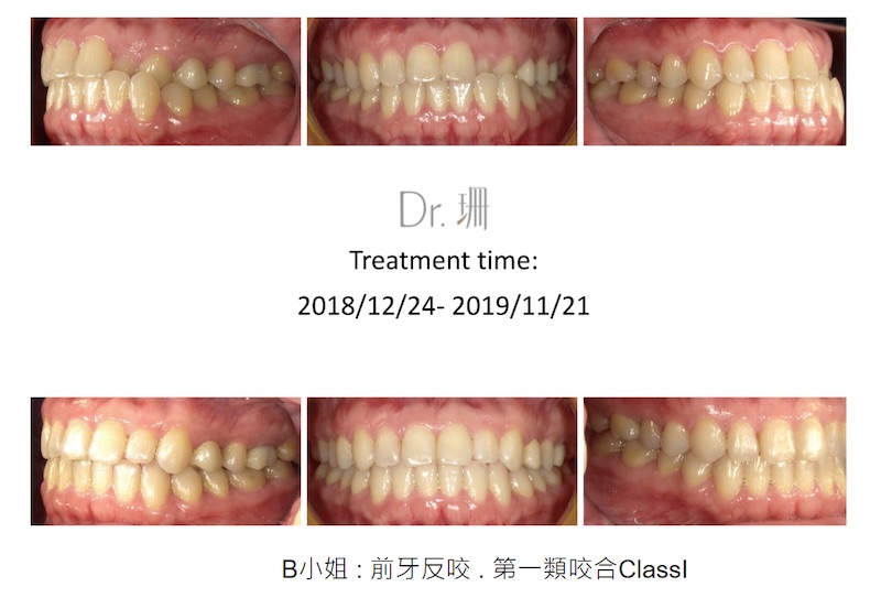 隱適美案例2:B小姐案例診斷為前牙反咬,屬於第一類咬合ClassI,適用輕矯正