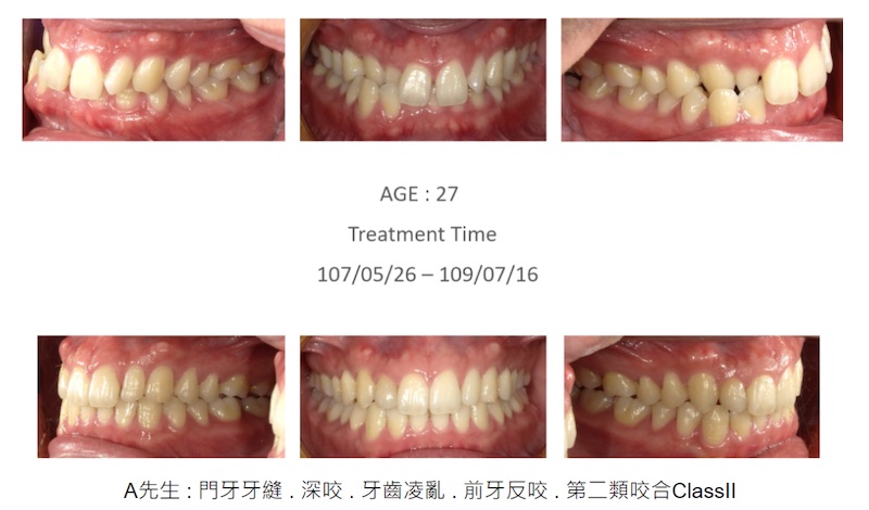 隱適美案例1：A先生診斷為門牙牙縫大、深咬、牙齒凌亂、前牙反咬，屬於第二類咬合ClassII，不適用輕矯正