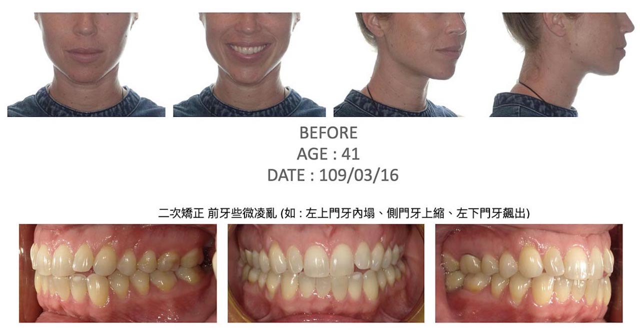 隱適美Lite輕矯正前的各角度臉型及咬合近照,有左上門牙內塌、側門牙上縮、左下門牙飆出等問題需進行二次矯正
