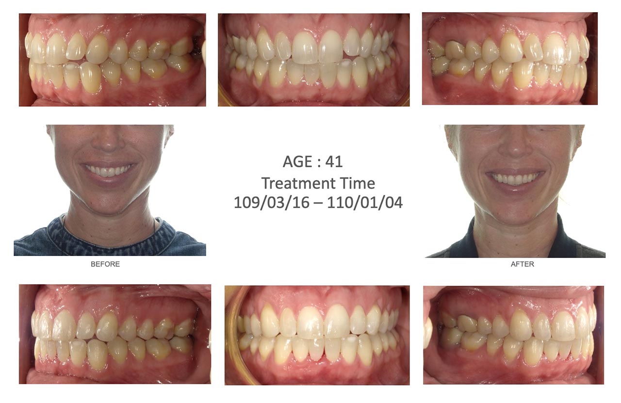 隱適美Lite輕矯正前後笑容臉型及咬合變化