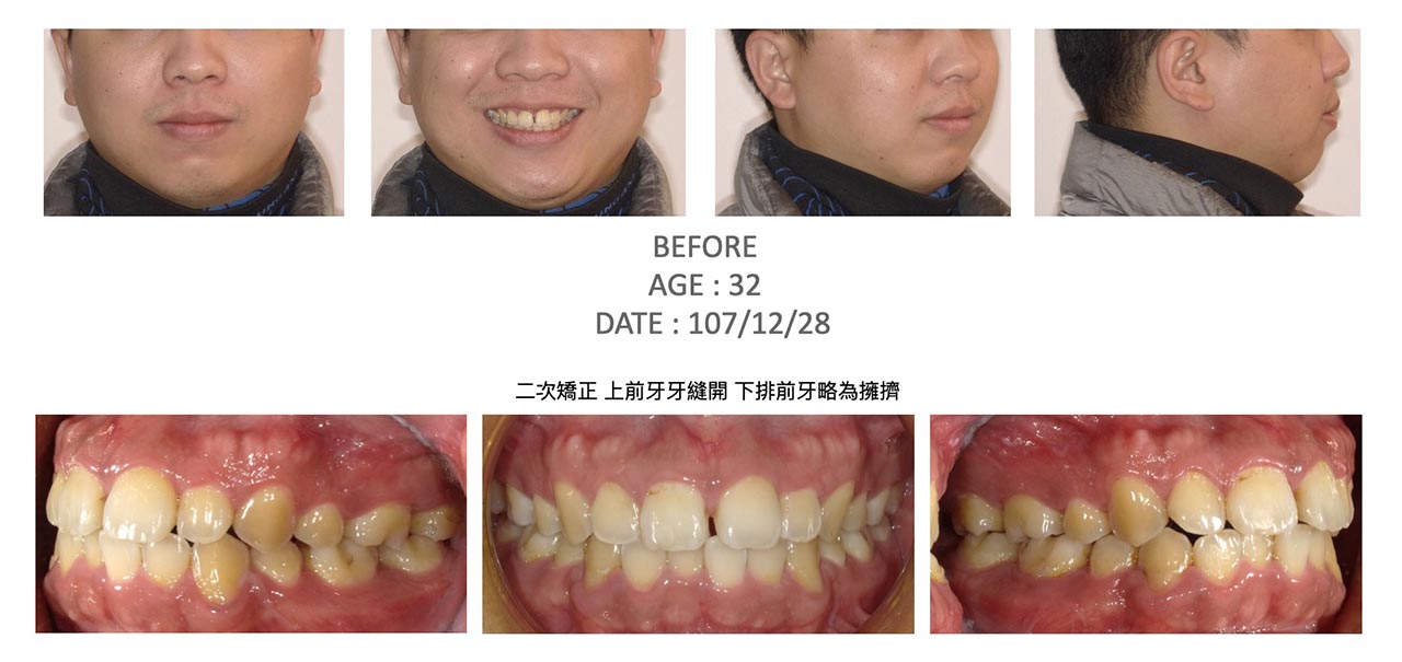 隱適美Lite輕矯正前的各角度臉型及咬合近照,有牙縫大、輕微牙齒擁擠等問題而需要進行二次矯正