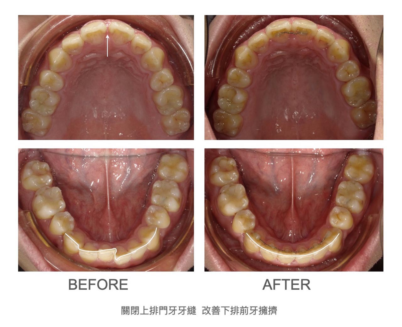 隱適美Lite輕矯正前後上下排牙弓形狀變化，關閉上排門牙牙縫，並改善下排前牙牙齒擁擠