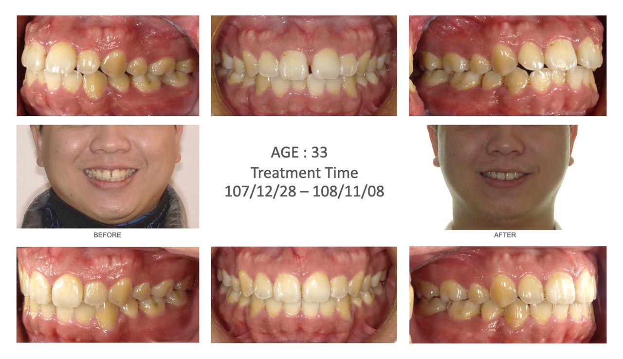 隱適美Lite輕矯正前後笑容臉型及咬合變化