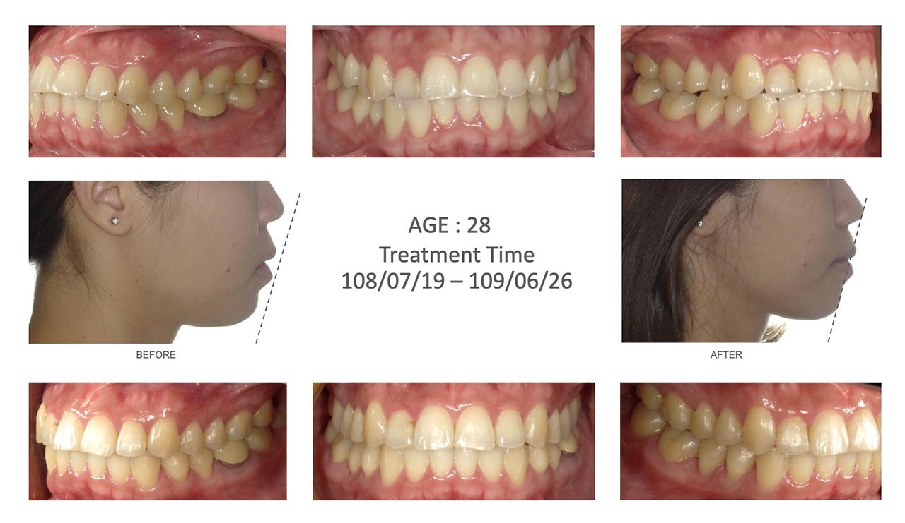 隱適美Lite輕矯正前後臉型及咬合變化