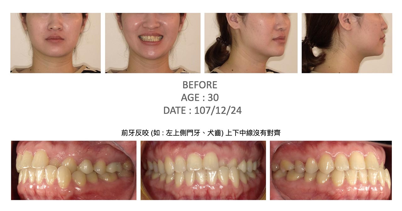 隱適美Lite輕矯正前的各角度臉型及咬合近照,有左上側門牙、犬齒反咬,以及上下排牙齒中線不齊等問題