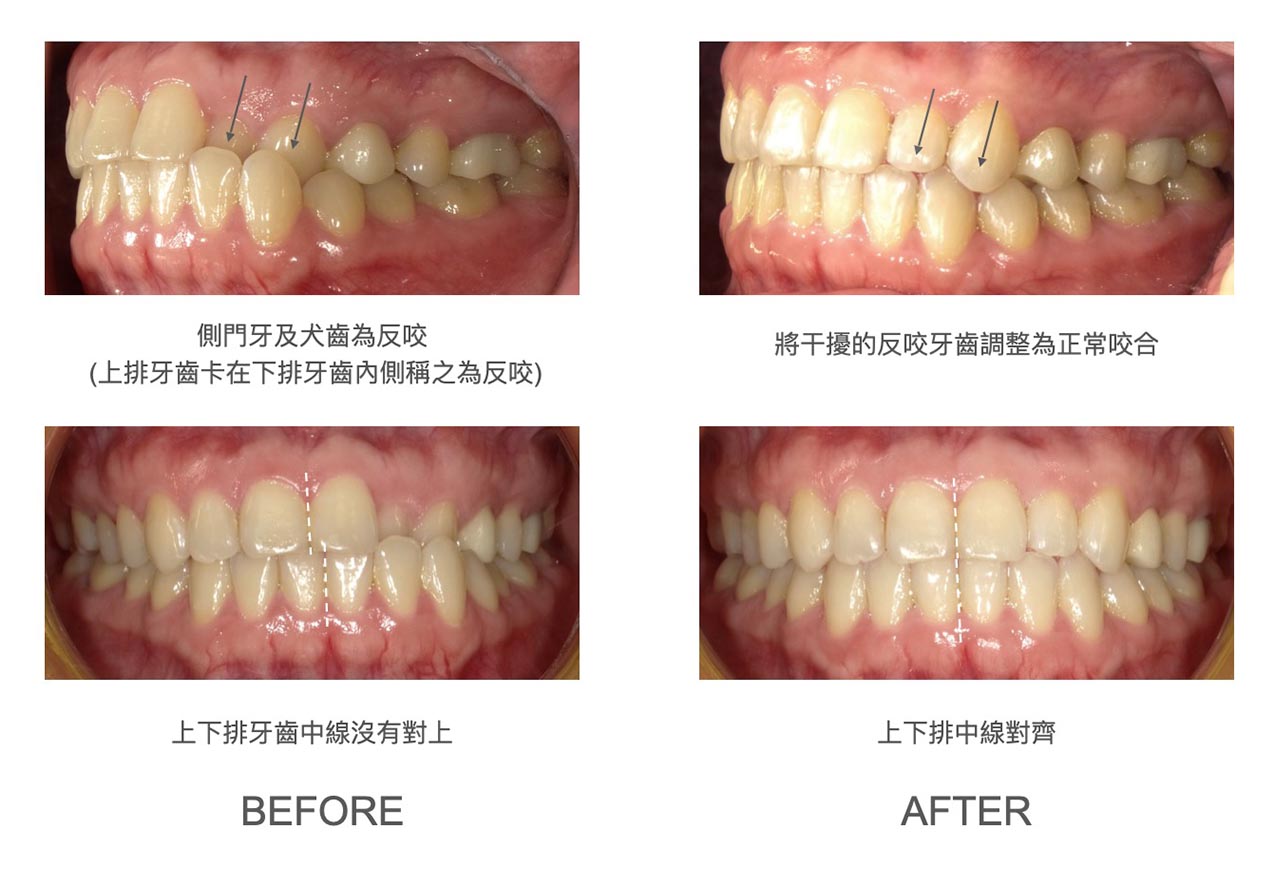 隱適美Lite輕矯正前後牙齒咬合變化，改善反咬的側門牙及犬齒，並將上下排牙齒中線對齊